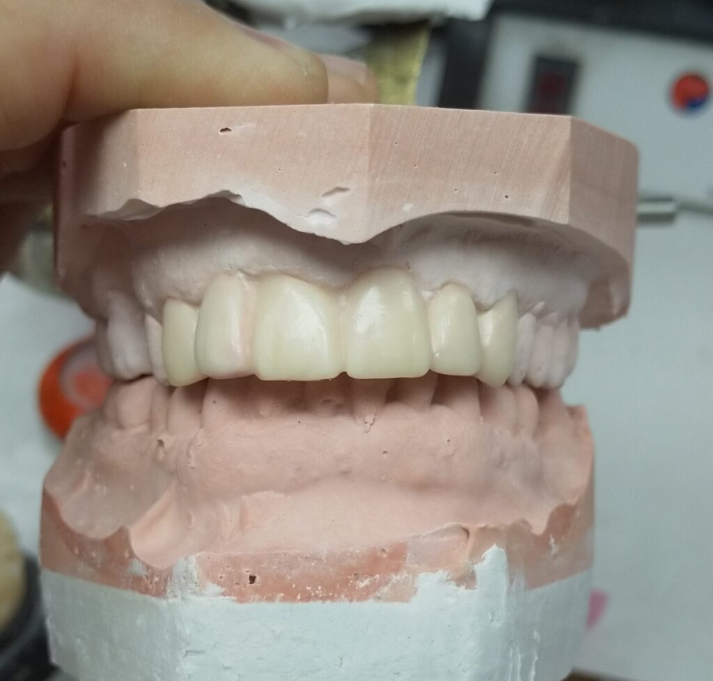 Férula de blanqueamiento