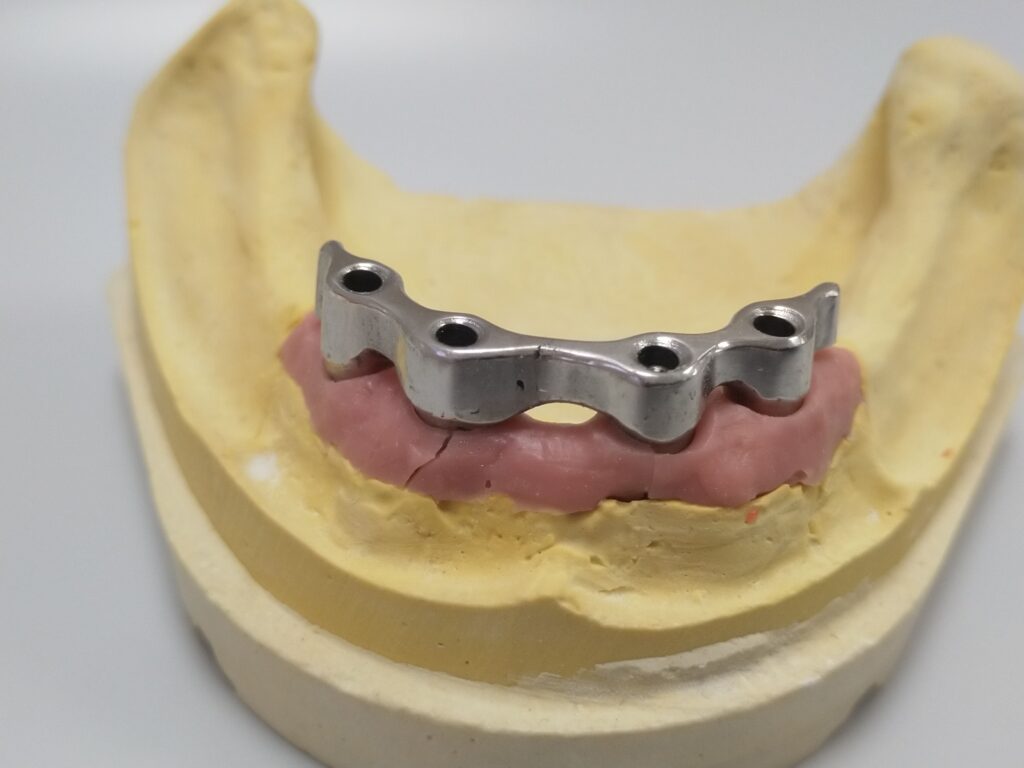 Prótesis sobre implantes