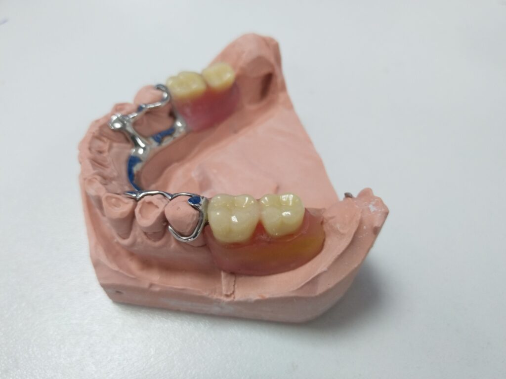 prótesis removibles