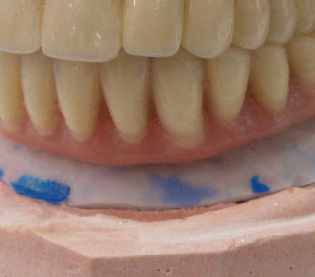 Prótesis sobre implantes